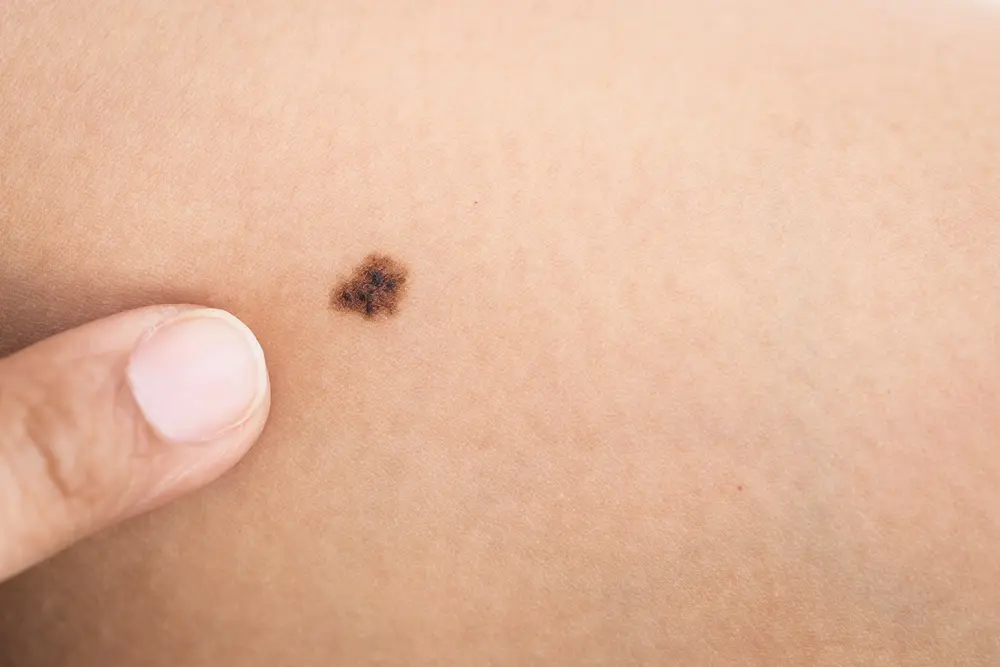 Melanoma example showing ABCDE characteristics - asymmetry, border, color, diameter, evolution