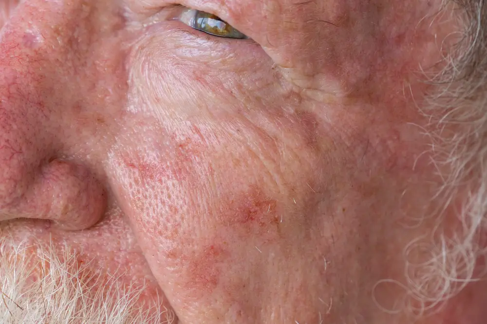Squamous cell carcinoma example showing typical appearance and characteristics